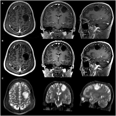 Thin-Slice Magnetic Resonance Imaging-Based Radiomics Signature Predicts Chromosomal 1p/19q Co-deletion Status in Grade II and III Gliomas
